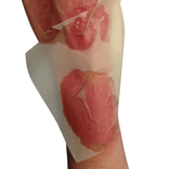 Nanogen sheet wound.png